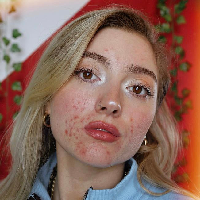 Dots for Spots on Instagram